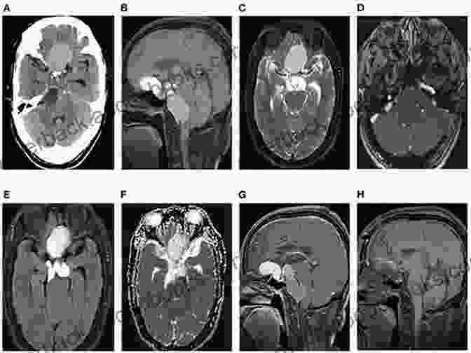 Craniopharyngioma Tumor Growth Patterns In Adults And Children Adult Craniopharyngiomas: Differences And Lessons From Paediatrics