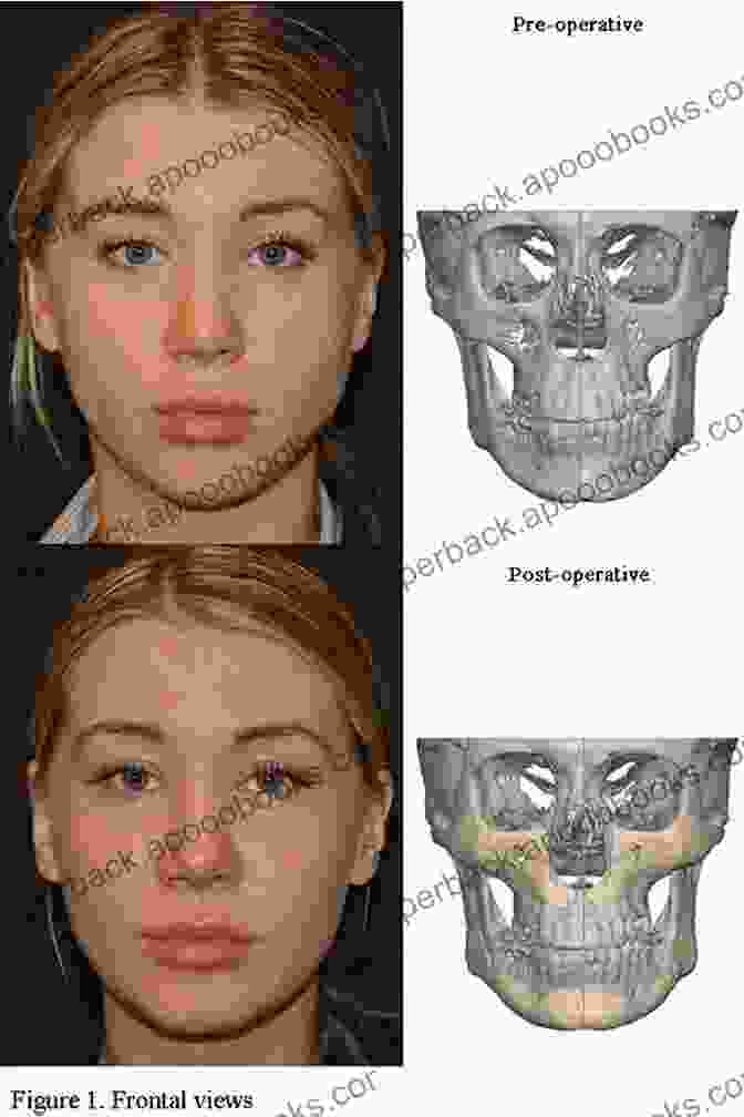 Custom Made Silicone Implants Designed Using Computer Aided Design Pectus Excavatum And Poland Syndrome Surgery: Custom Made Silicone Implants By Computer Aided Design