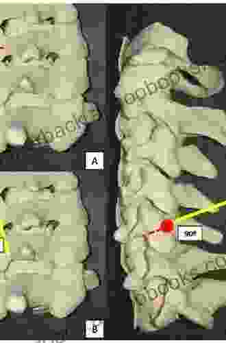 Lateral Mass Fixation In Sub Axial Cervical Spine